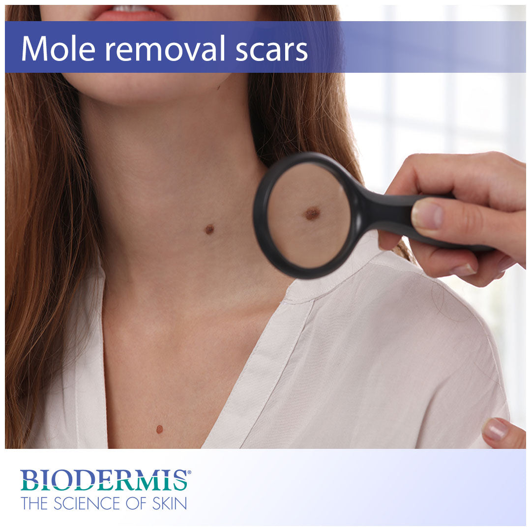 Mole Removal Scar Treatment  |  Biodermis.com Biodermis