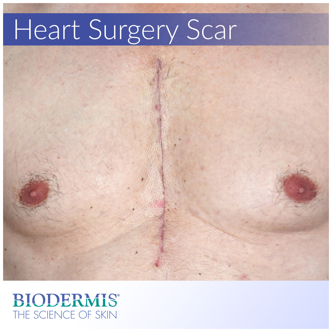 Open Heart Surgery and Scar Care | Biodermis.com