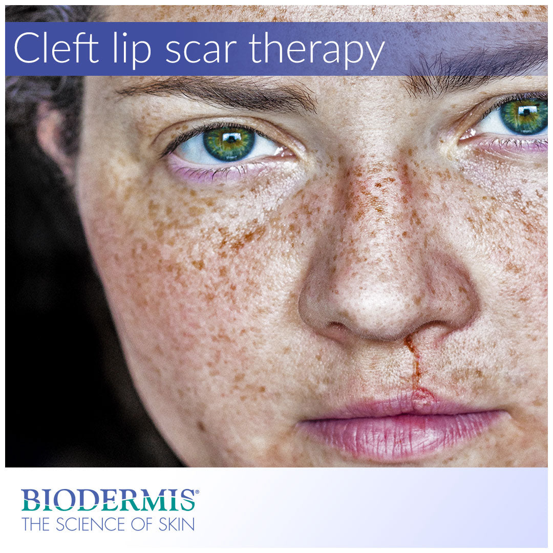 Scar Treatment for Cleft Lip Surgery | Biodermis.com Biodermis