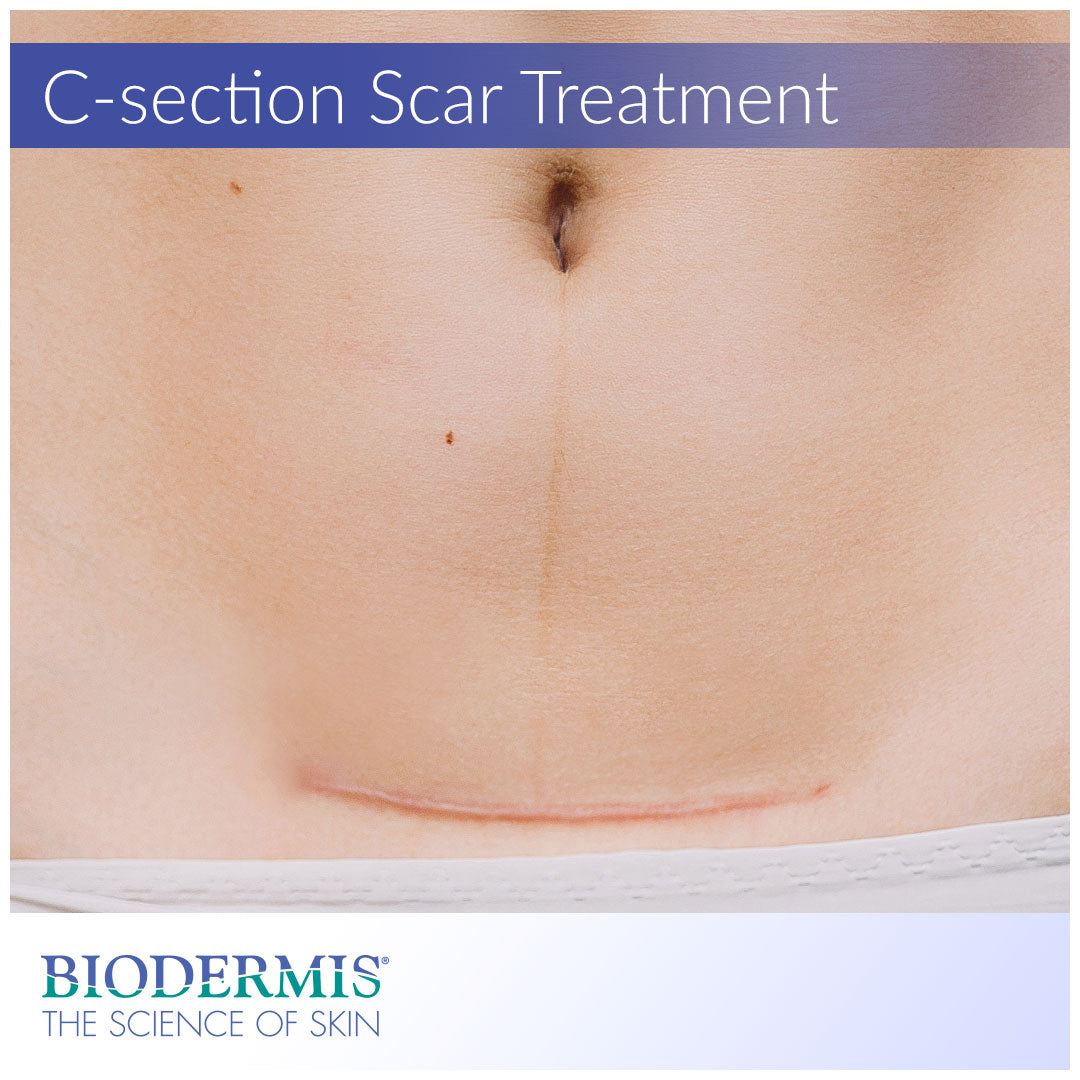 The Best Way to Treat a C-section Scar | Biodermis.com Biodermis