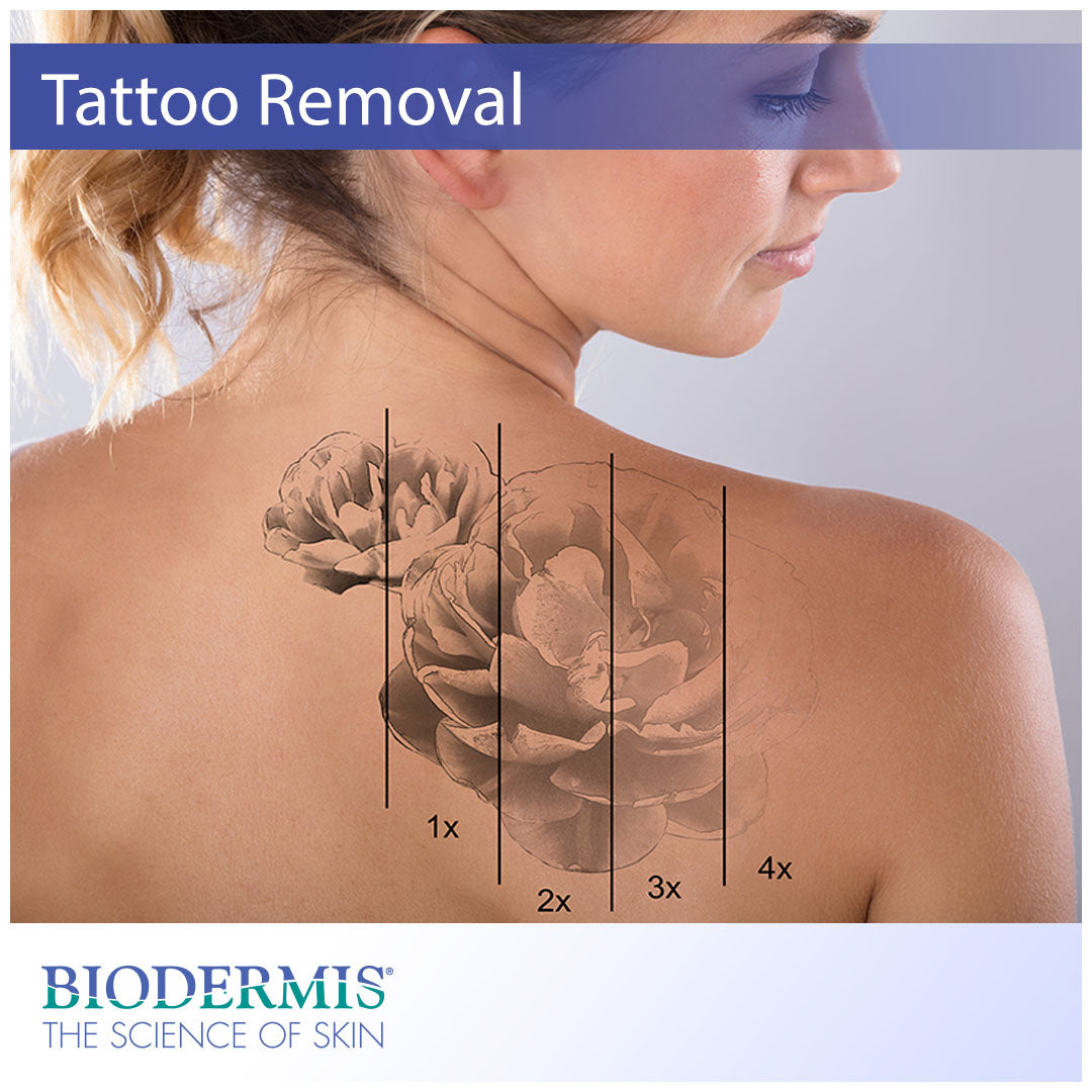 The Scar Management Side of Tattoo Removal | Biodermis.com