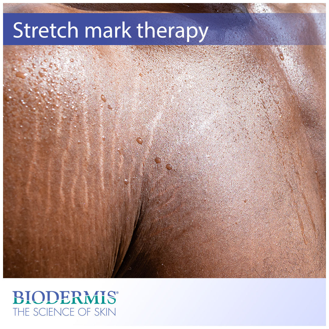 A Scientific Approach to Stretch Mark Therapy | Biodermis.com Biodermis