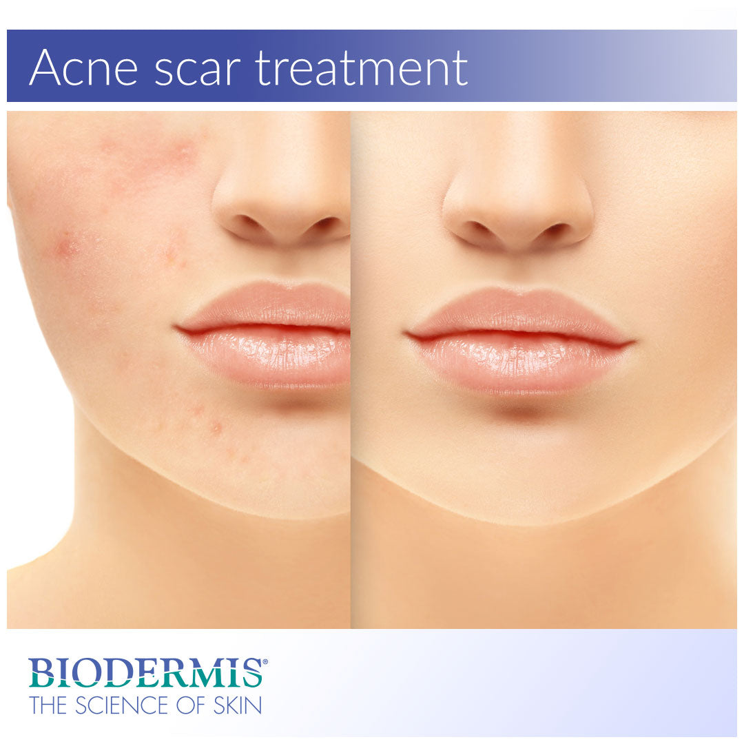Acne Scar Treatment: Medical Silicone  |  Biodermis.com Biodermis