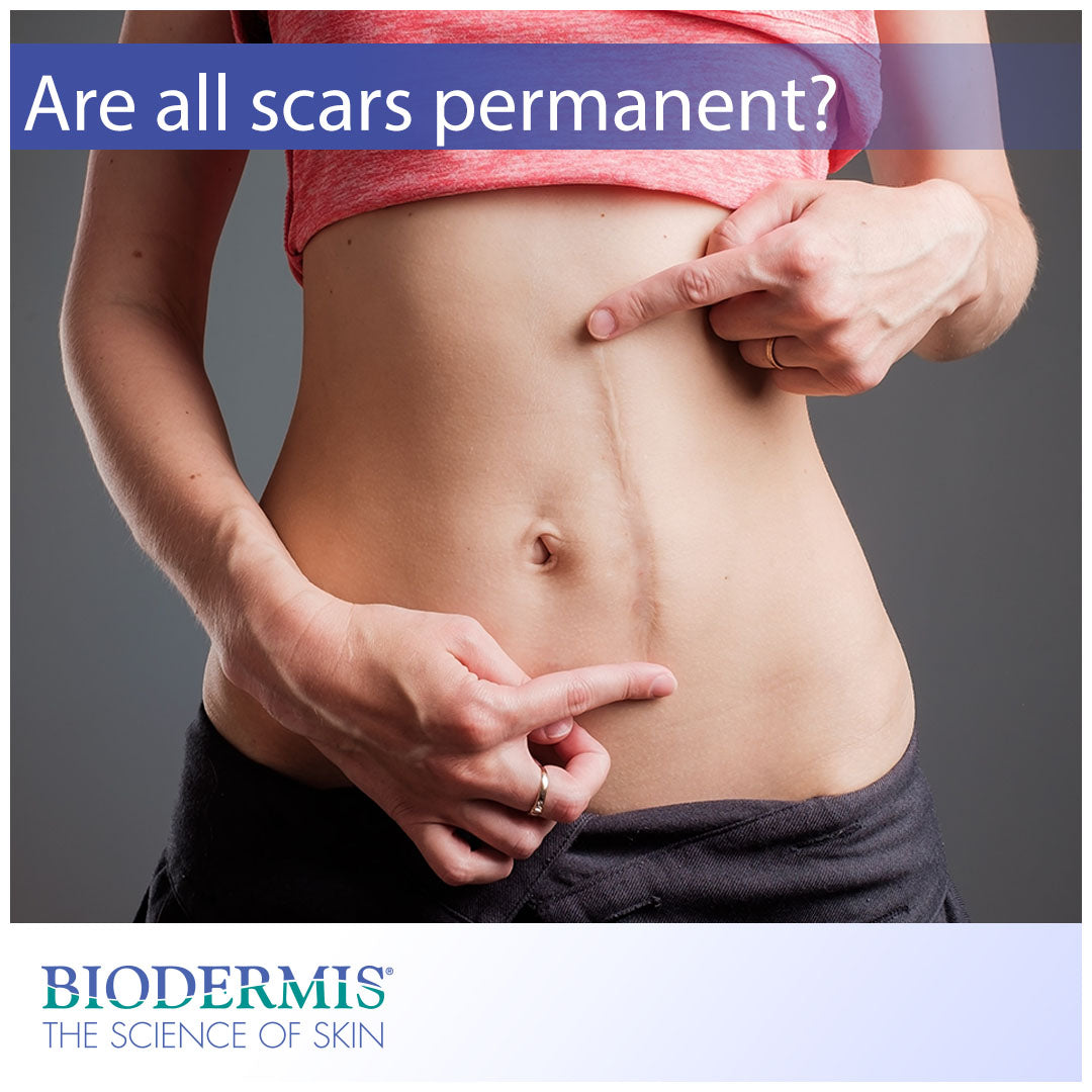 Are All Scars Permanent? |  Biodermis.com Biodermis