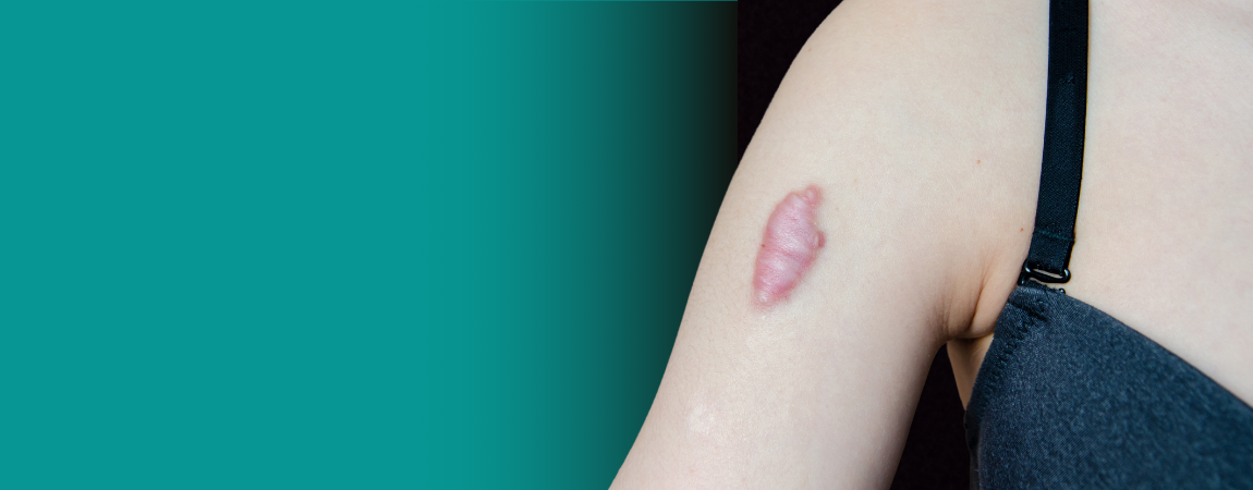 Best Scar Treatments - Options That Actually Work