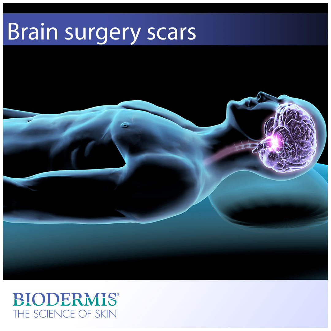 Brain Surgery Scar Care |  Biodermis.com Biodermis