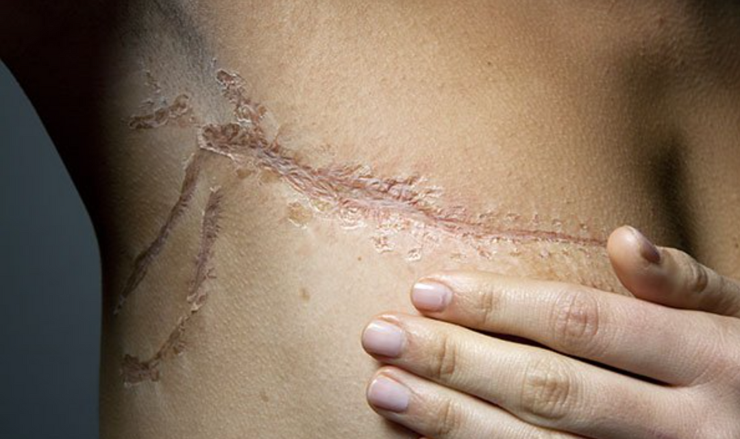 Lymphedema and Scars: What Do They Have in Common?