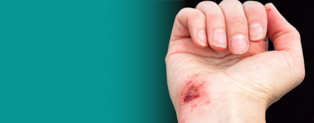 Comprehensive Guide to Wound Care and Management