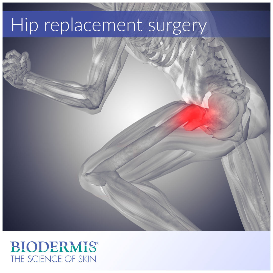 Hip Replacement Surgery and Scar Management  |  Biodermis.com Biodermis