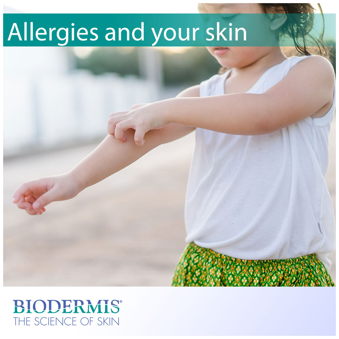 How Do Allergies Affect the Skin? | Biodermis.com Biodermis
