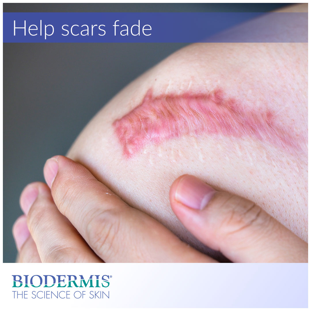 How Long Does it Take for a Scar to Fade? |  Biodermis.com Biodermis