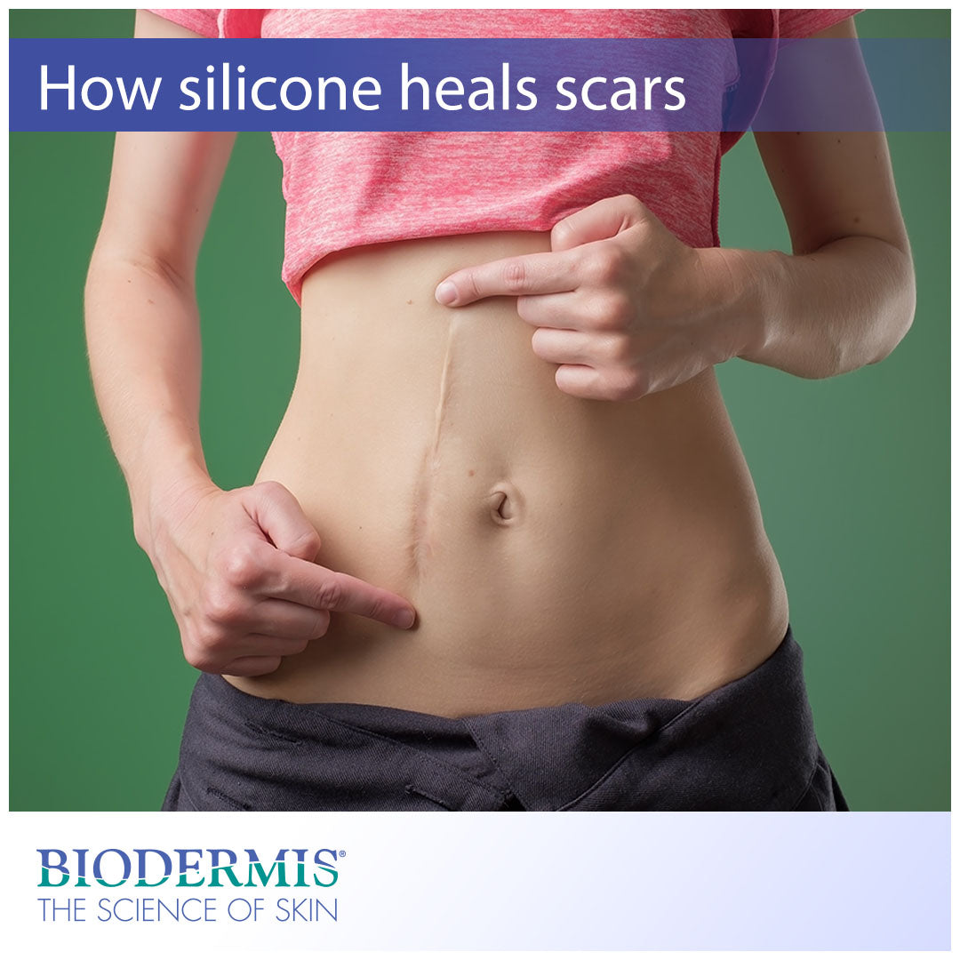 How Silicone Helps Scars Heal  |  Biodermis.com Biodermis