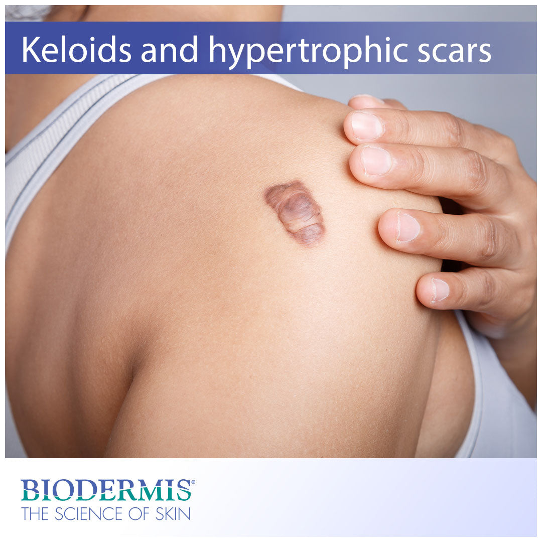 How To Prevent Keloids and Hypertrophic Scars | Biodermis.com Biodermis