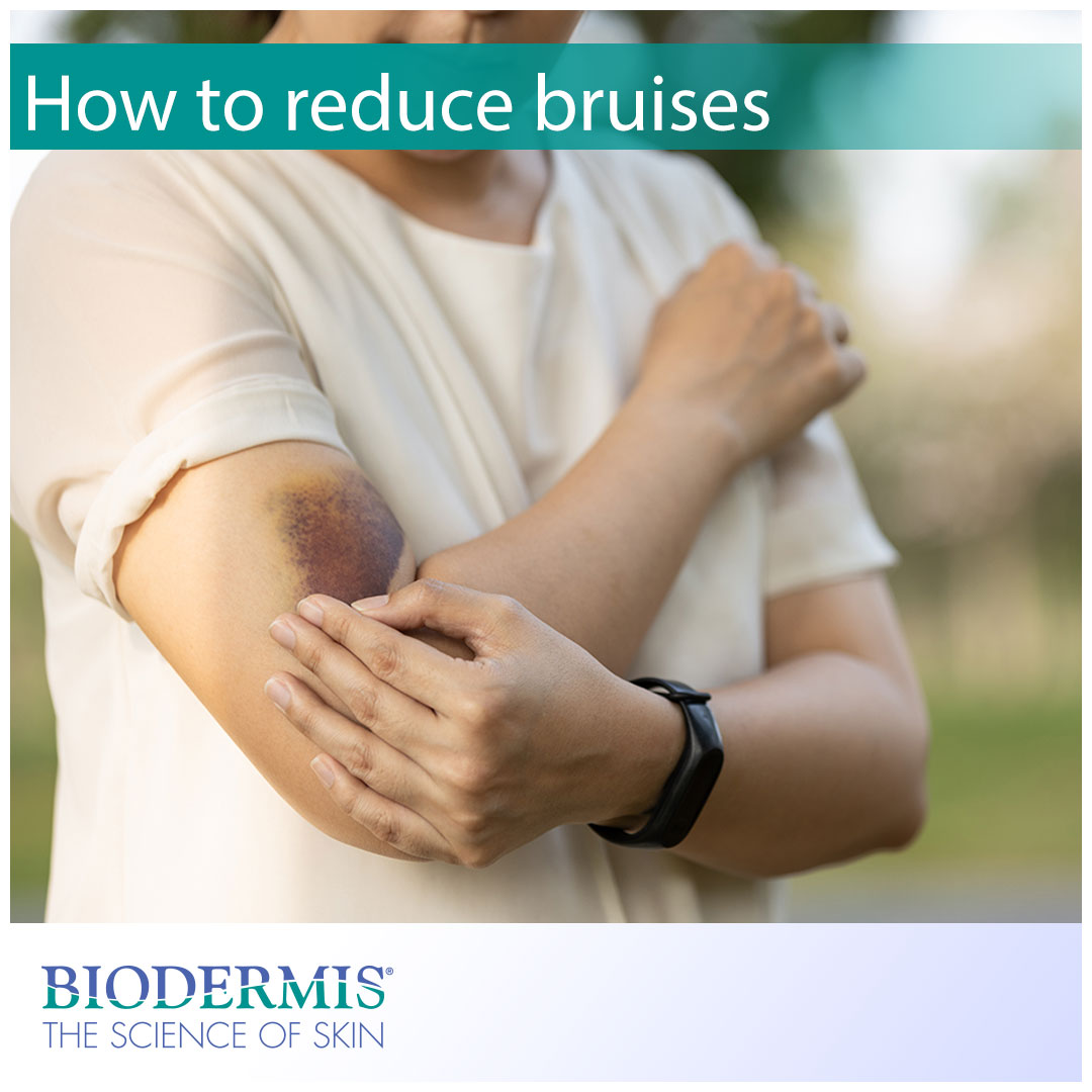 How to Reduce Bruising After a Medical Procedure | Biodermis.com Biodermis