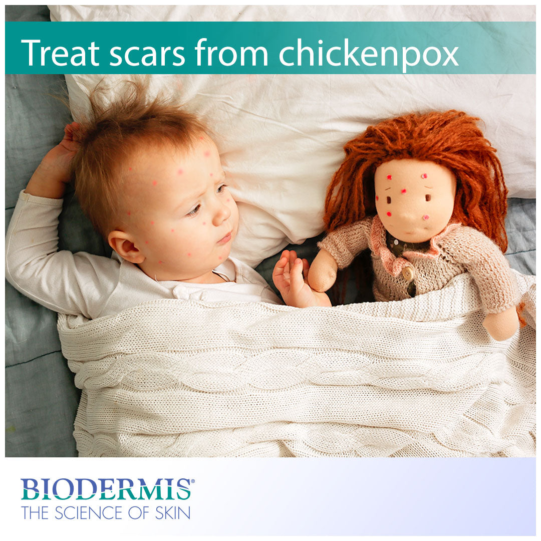 How to Treat Scars from Chickenpox |  Biodermis.com Biodermis
