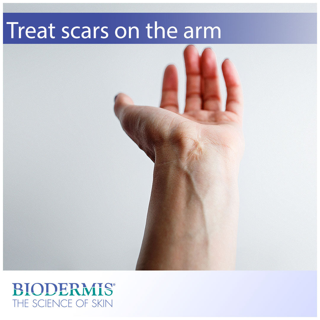 How to Treat Scars on Your Arms | Biodermis.com