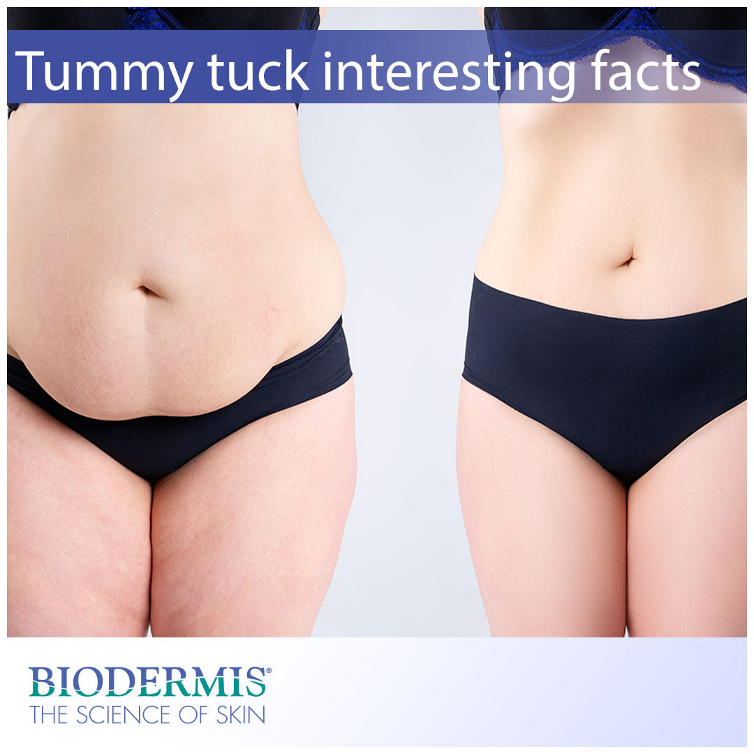 Interesting Facts About Tummy Tucks | Biodermis.com Biodermis