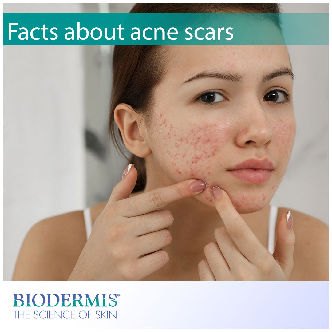 Interesting Facts about Acne Scars | Biodermis.com Biodermis