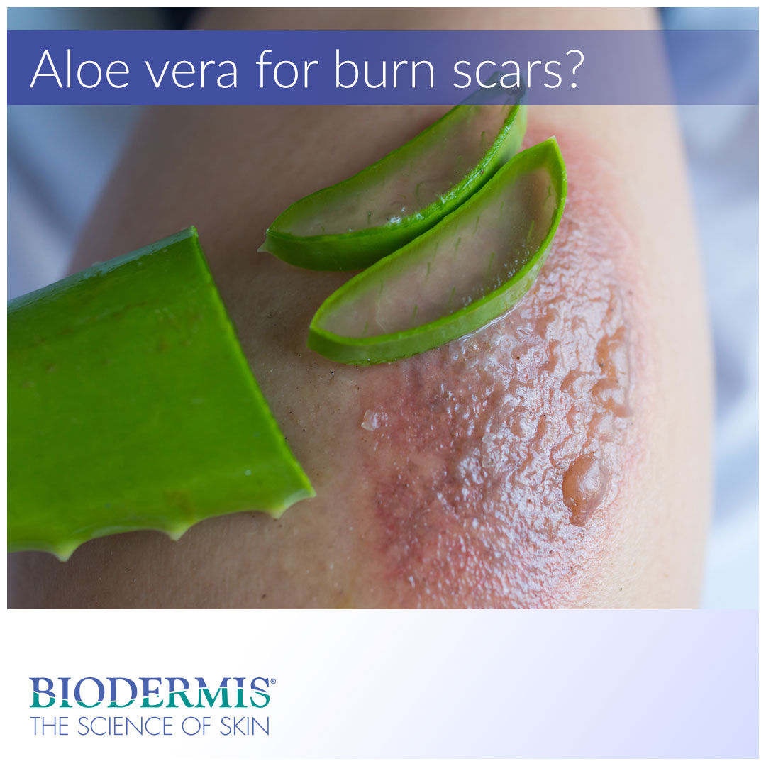 https://www.biodermis.com/cdn/shop/articles/Is-Aloe-Vera-Good-For-Burn-Scars-Biodermis-com-Biodermis-2864.jpg?v=1693382013