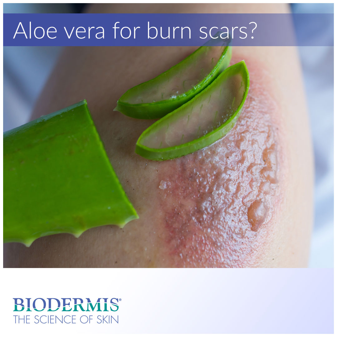 Is Aloe Vera Good For Burn Scars | Biodermis.com Biodermis