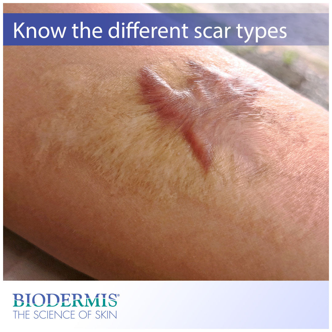 Know the Different Types of Scars and How to Treat Them  |  Biodermis.com Biodermis