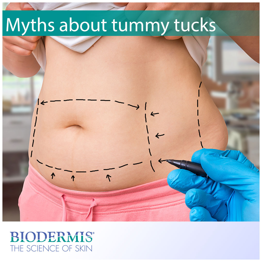 Myths About Tummy Tuck Procedures | Biodermis.com Biodermis