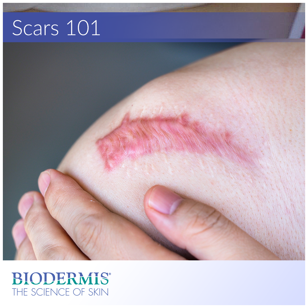 Scars 101 – Biodermis