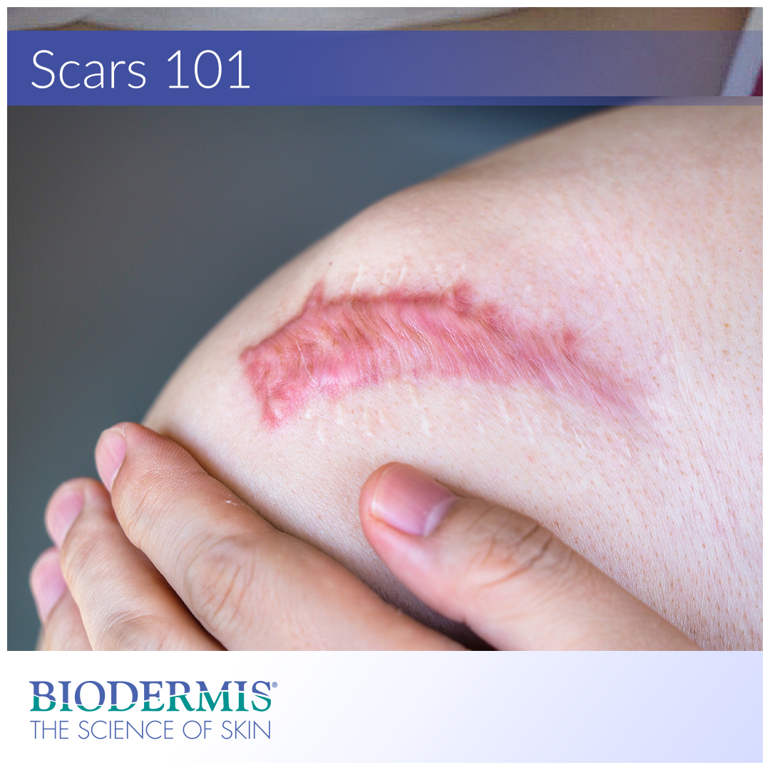 Scars 101