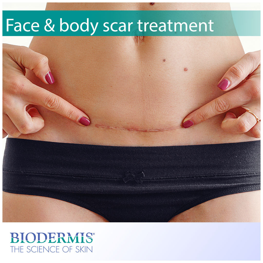 Silicone for Face & Body Scars | Biodermis.com Biodermis