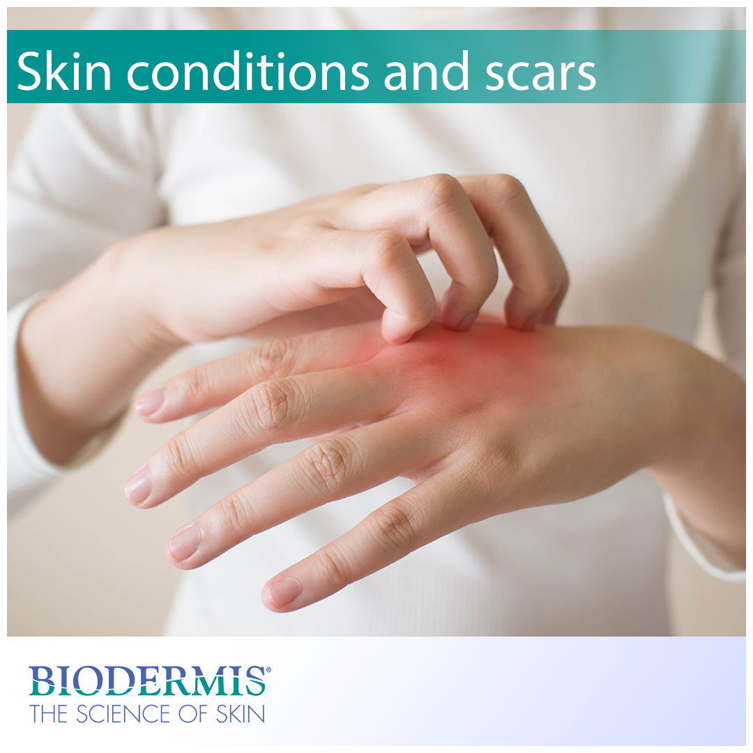 Skin Conditions That Cause Scars | Biodermis.com Biodermis