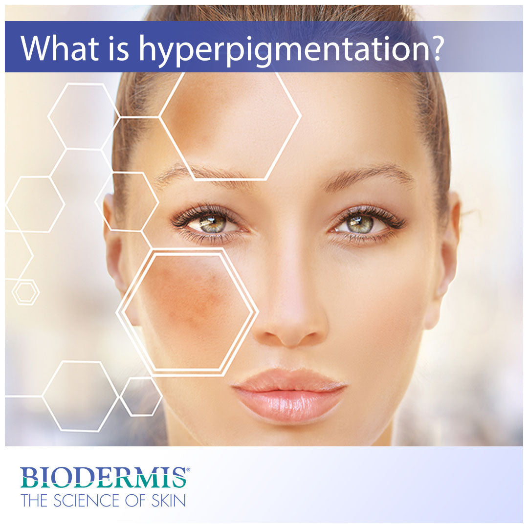 Skin Hyperpigmentation and How to Prevent It |  Biodermis.com Biodermis