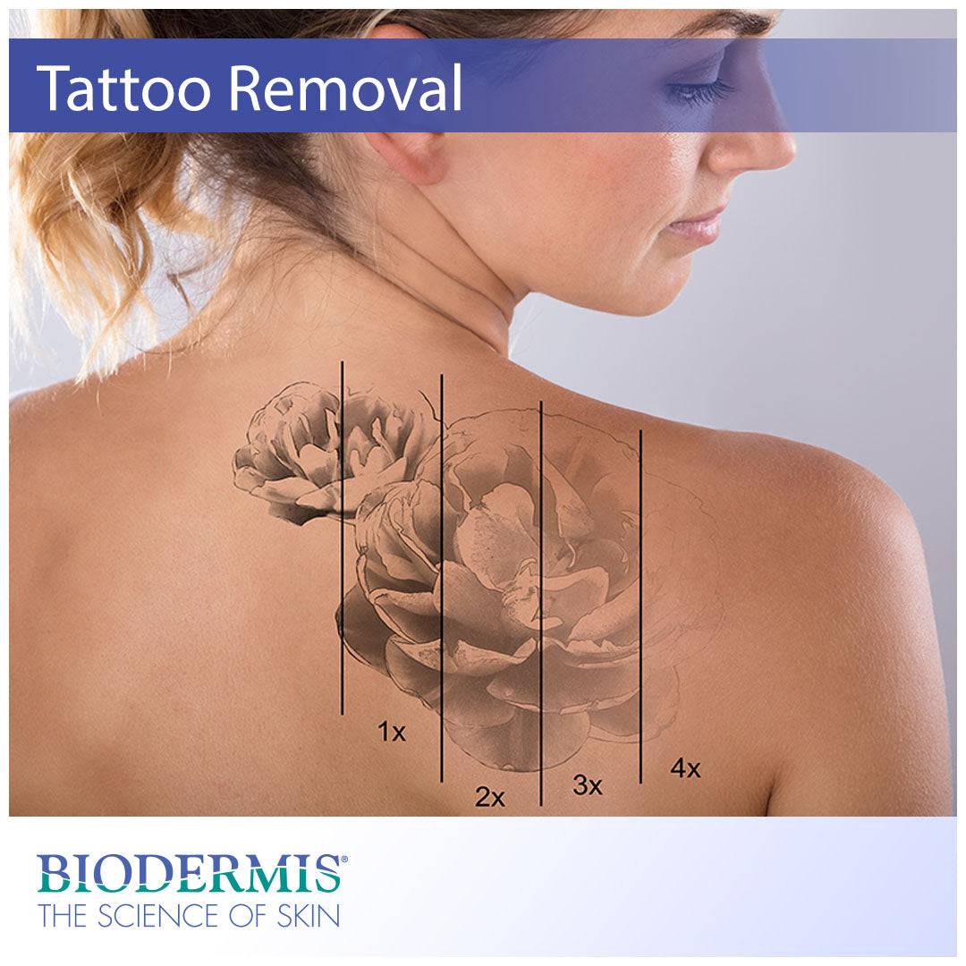 The Scar Management Side of Tattoo Removal |  Biodermis.com Biodermis