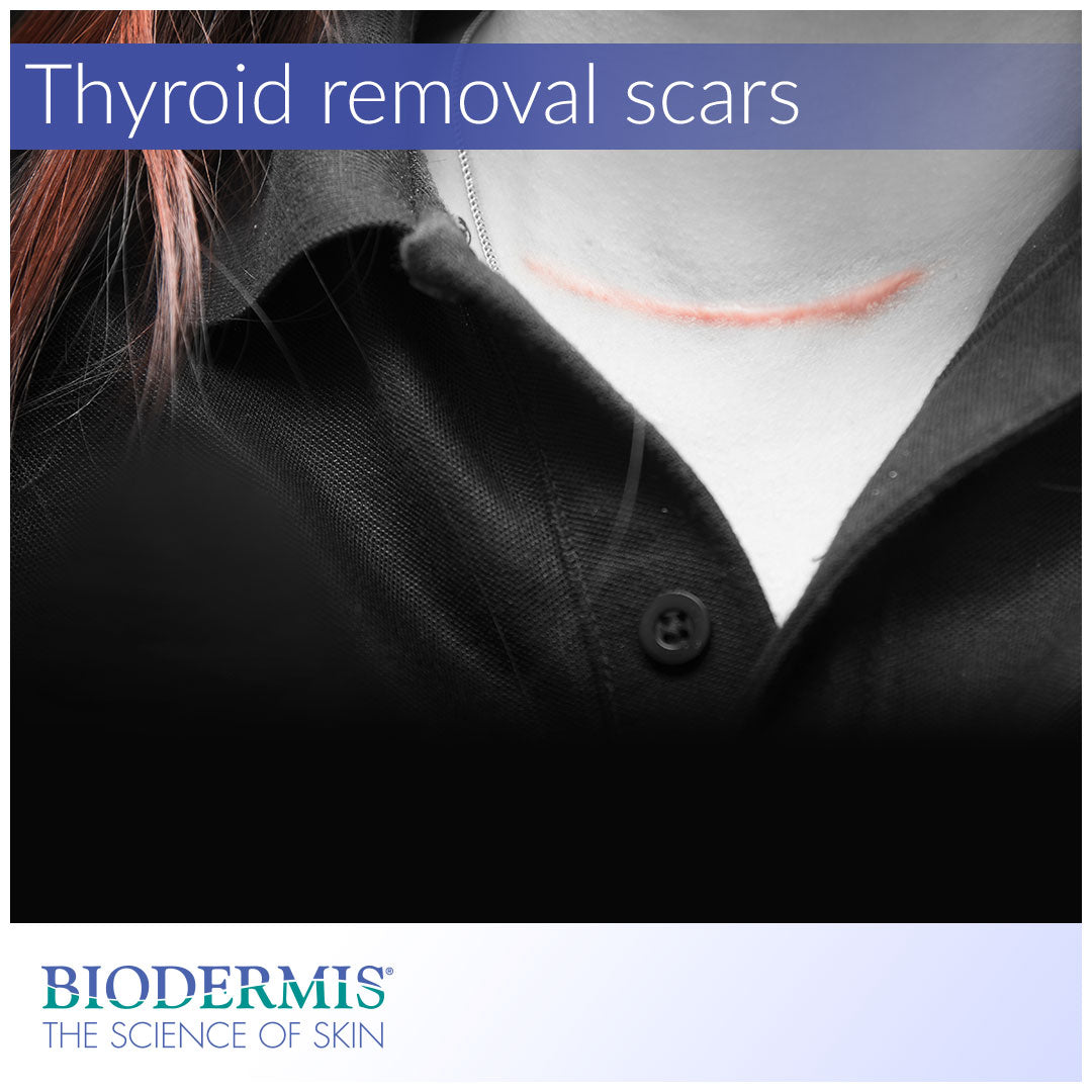Thyroid Surgery Scar Care  |  Biodermis.com Biodermis