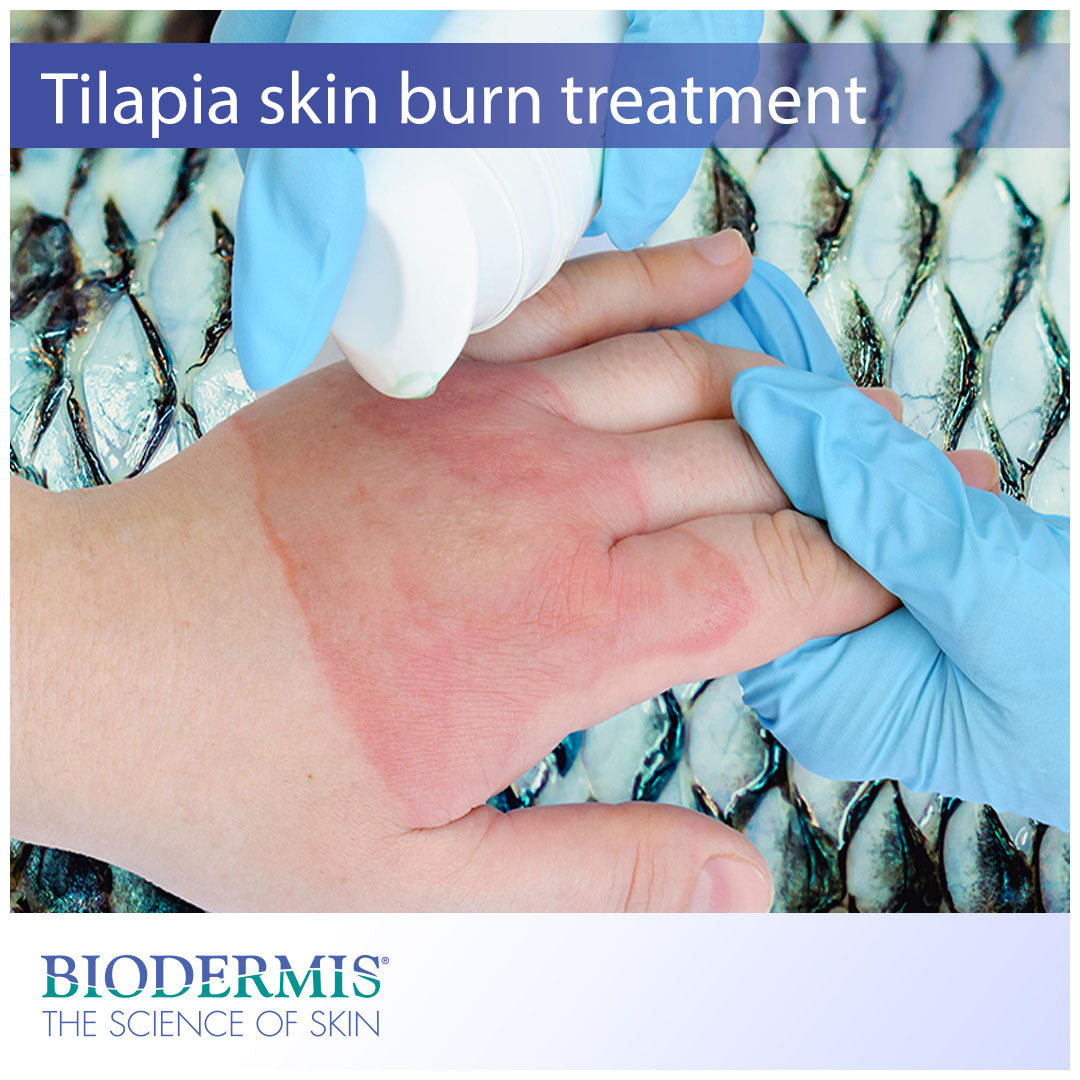 Tilapia Skin and other Burn Treatment Techniques  |  Biodermis.com Biodermis