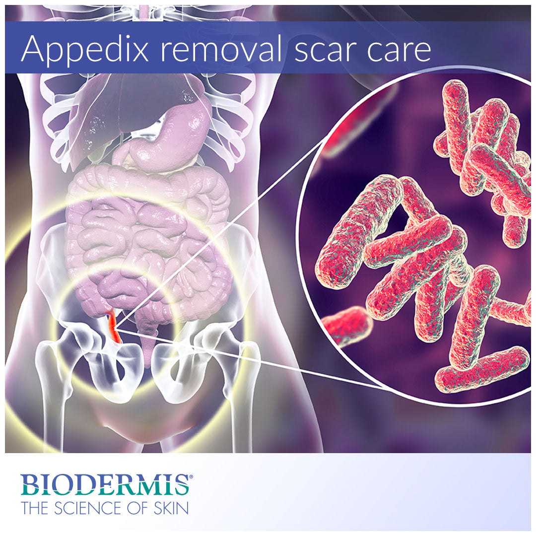 Appendix Removal Scar