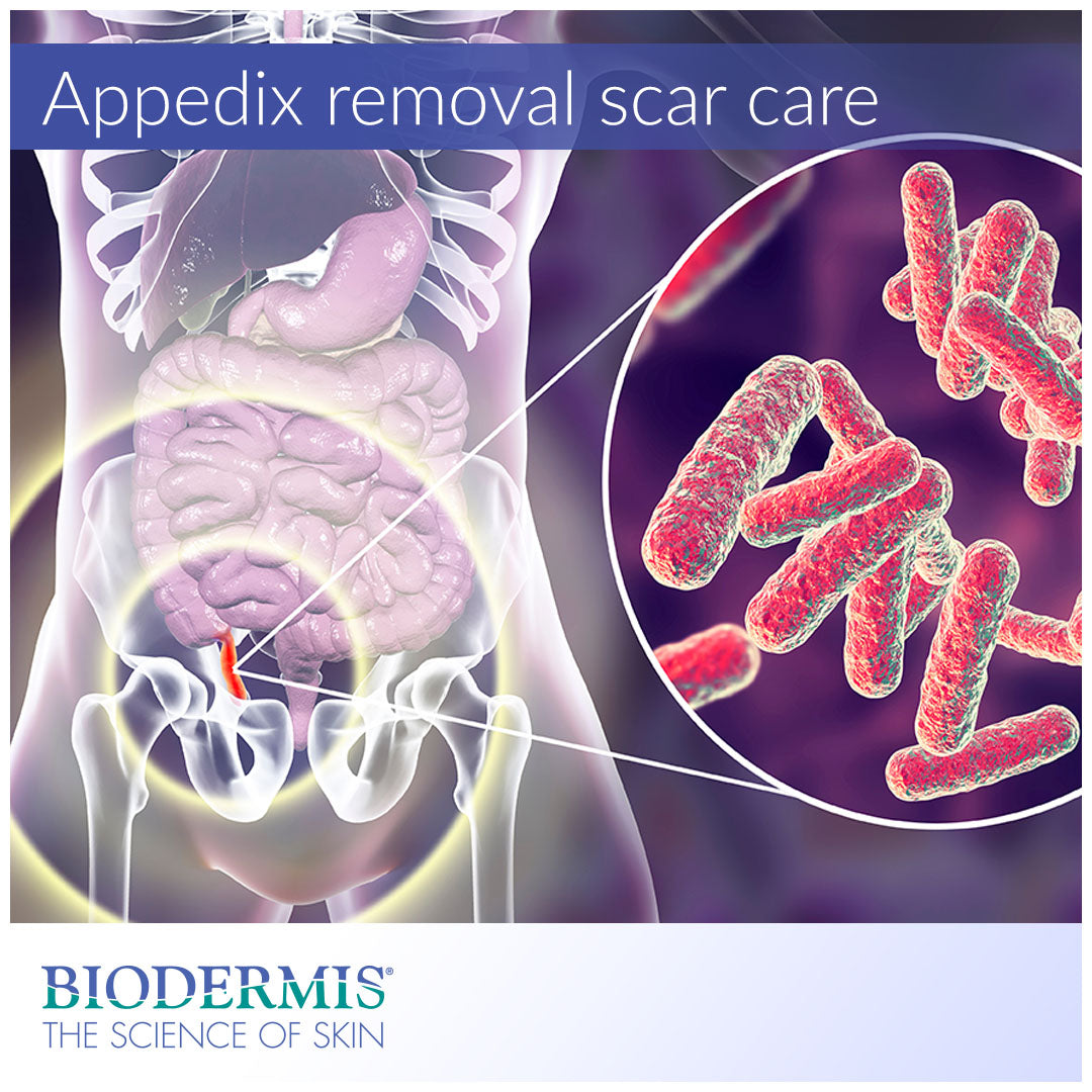 Treating Your Scar After Appendix Removal  |  Biodermis.com Biodermis