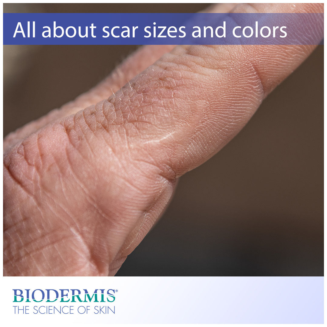 What Do the Size and Color of Your Scar Mean? |  Biodermis.com Biodermis