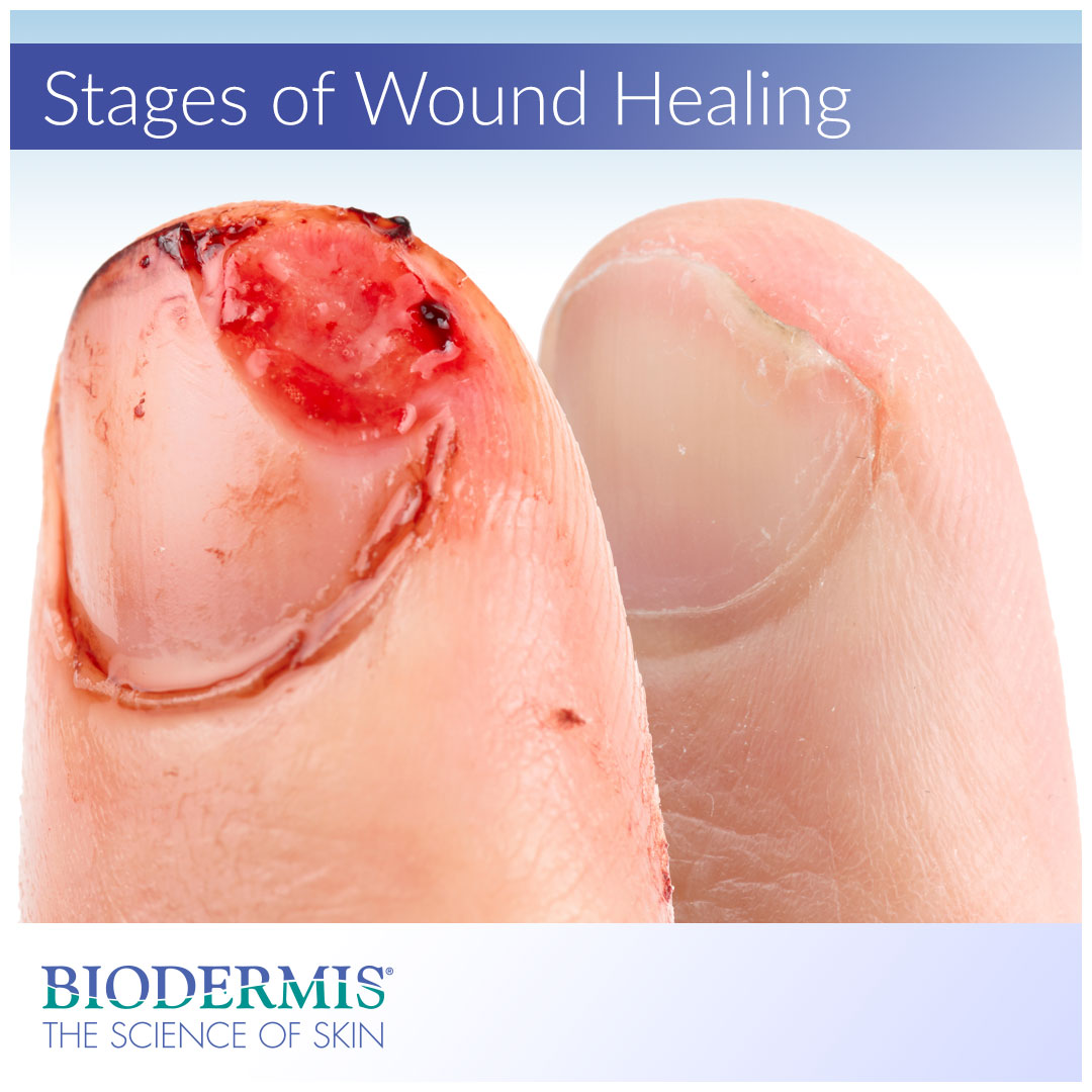 What are the Stages of Wound Healing? | Biodermis.com Biodermis
