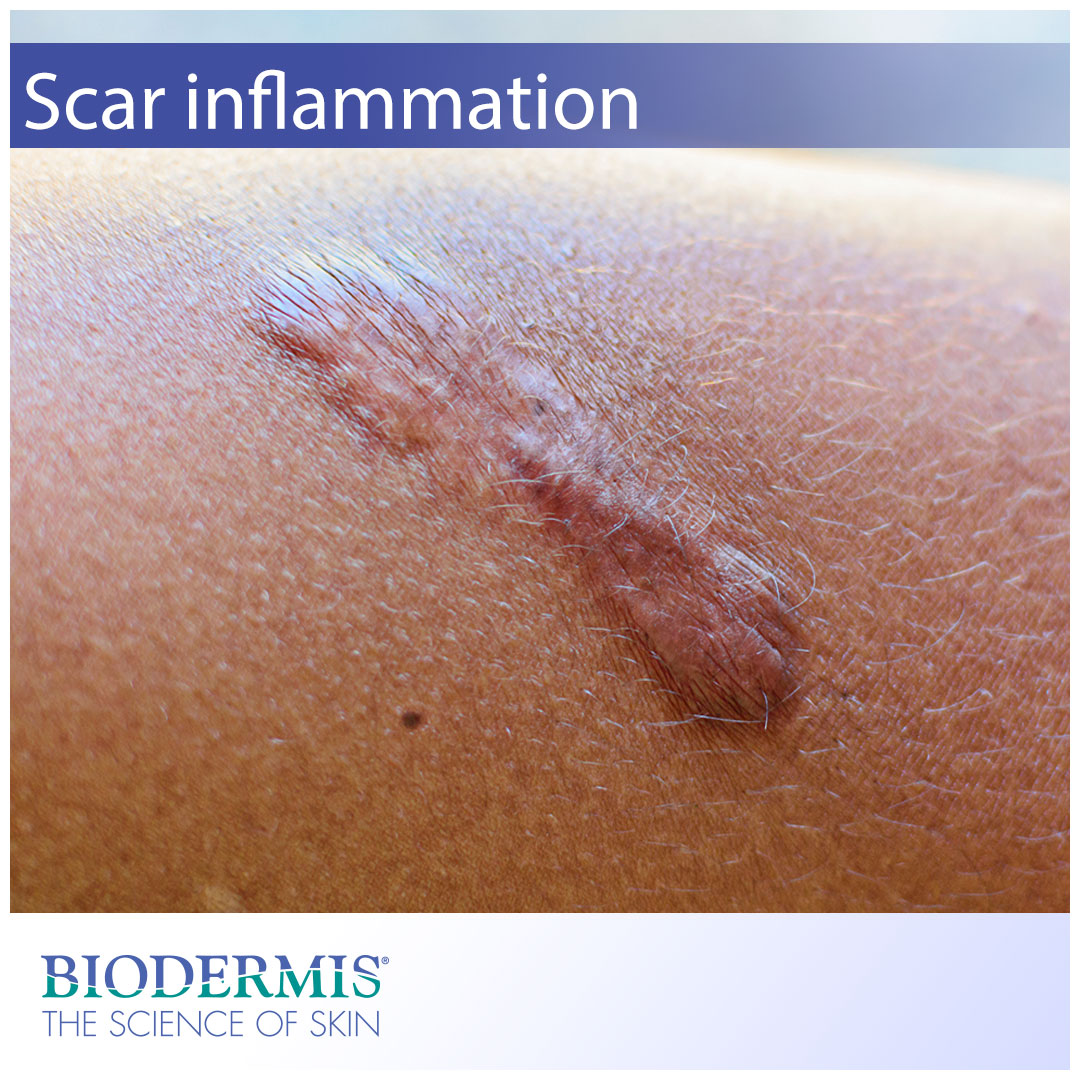What to Do About Scar Inflammation | Biodermis.com Biodermis