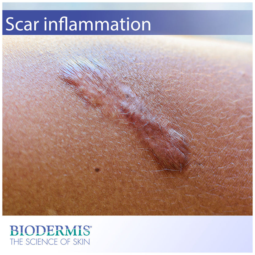 What to Do About Scar Inflammation | Biodermis.com