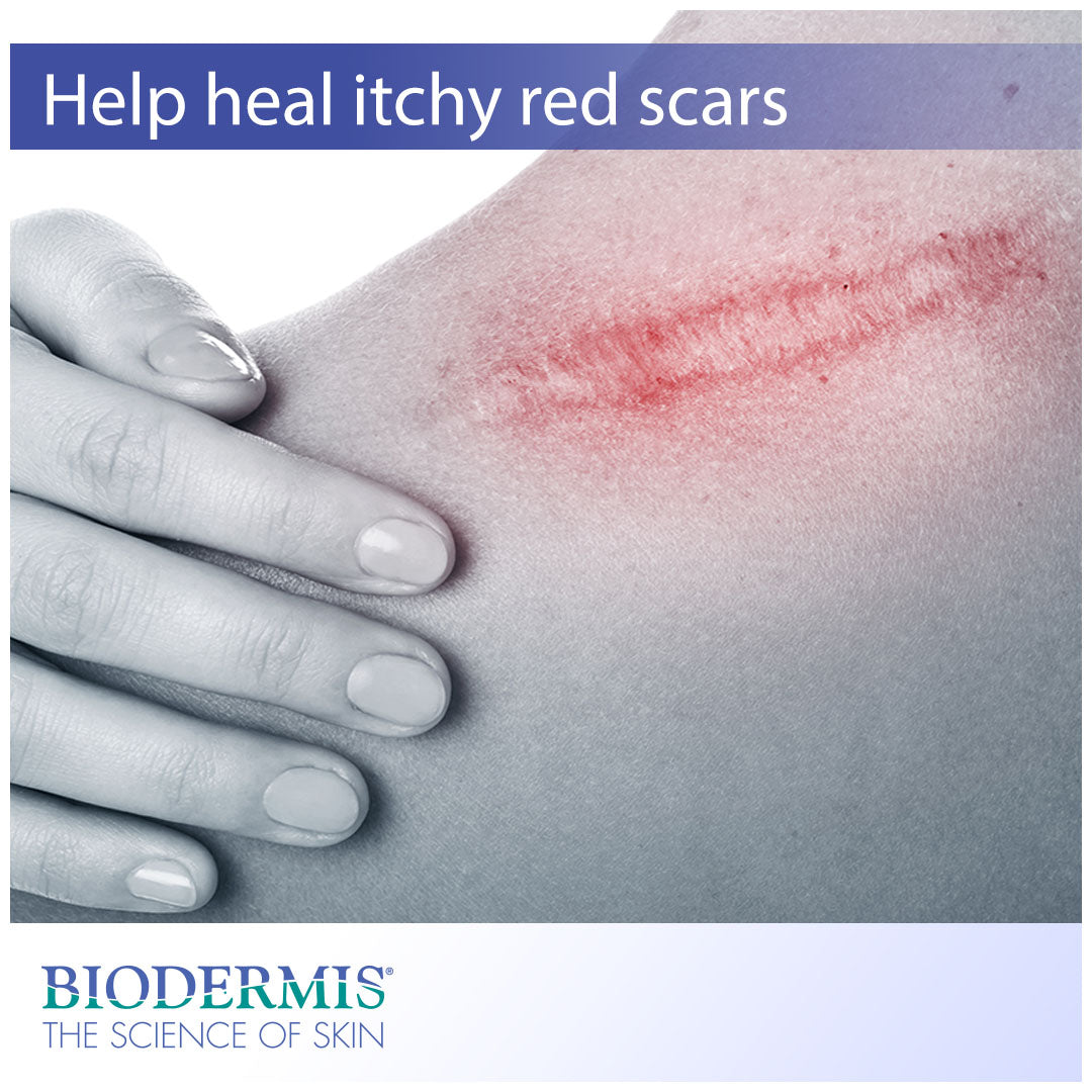 What to do About Itchy Red Scars | Biodermis.com Biodermis