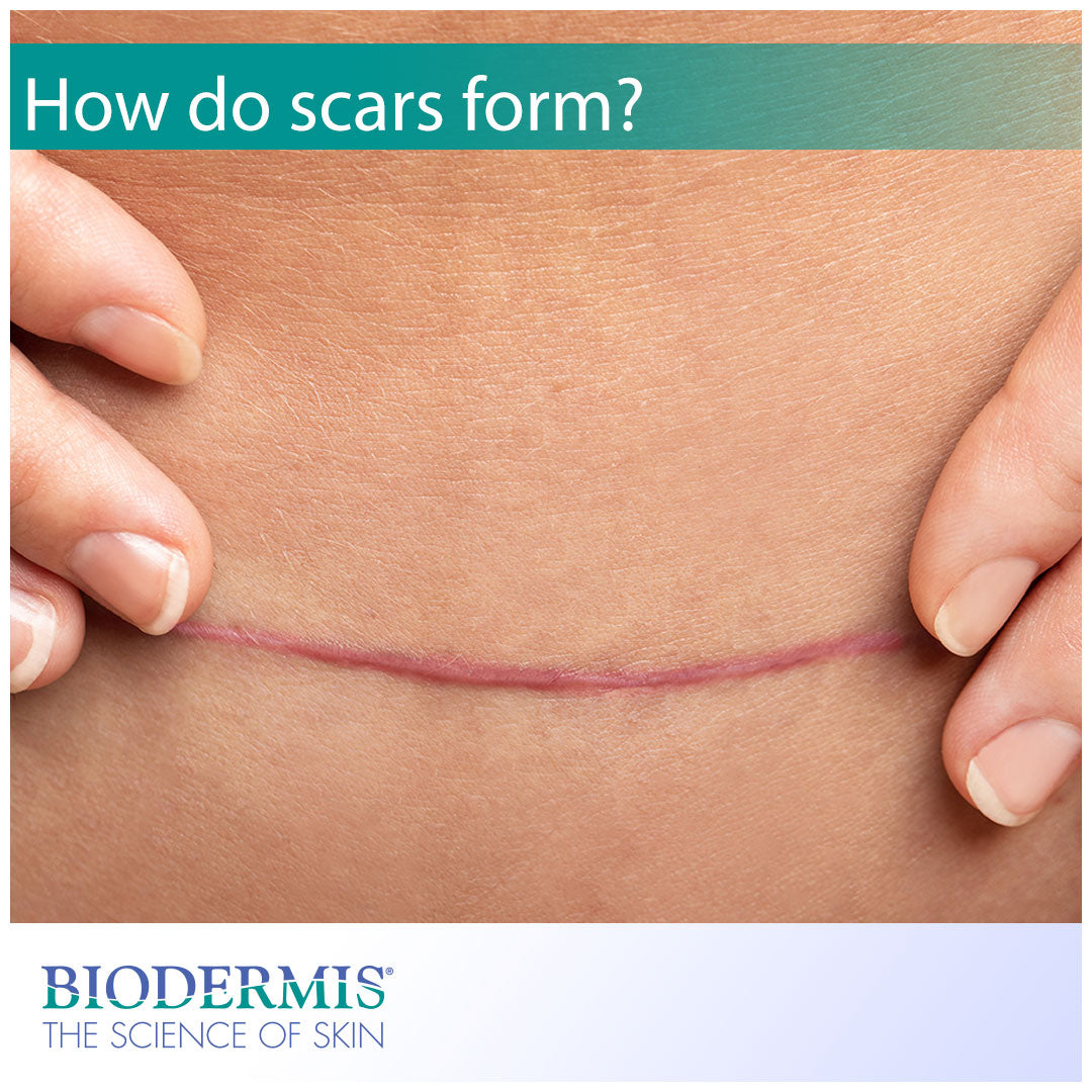 Scar Notes Form Why Do Scars Form? | Biodermis.com
