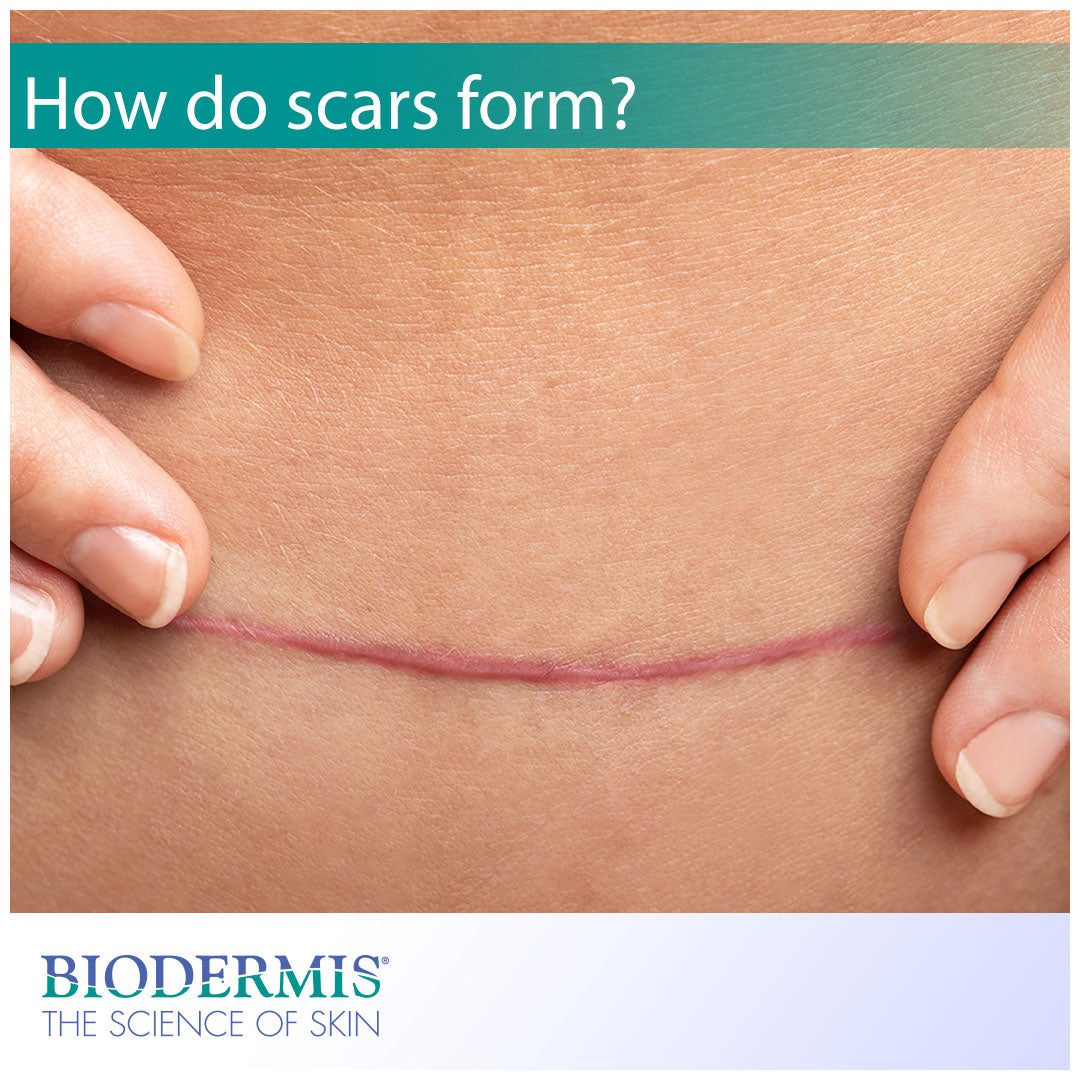 Why Do Scars Form? | Biodermis.com Biodermis