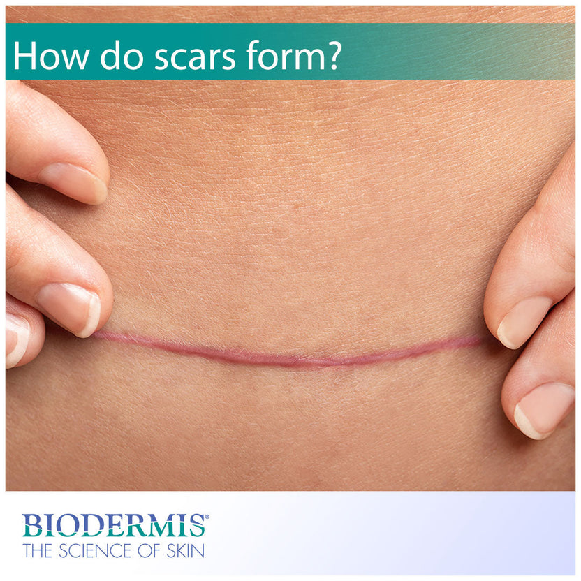 Normal Scar Formation Process Why Do Scars Form? | Biodermis.com