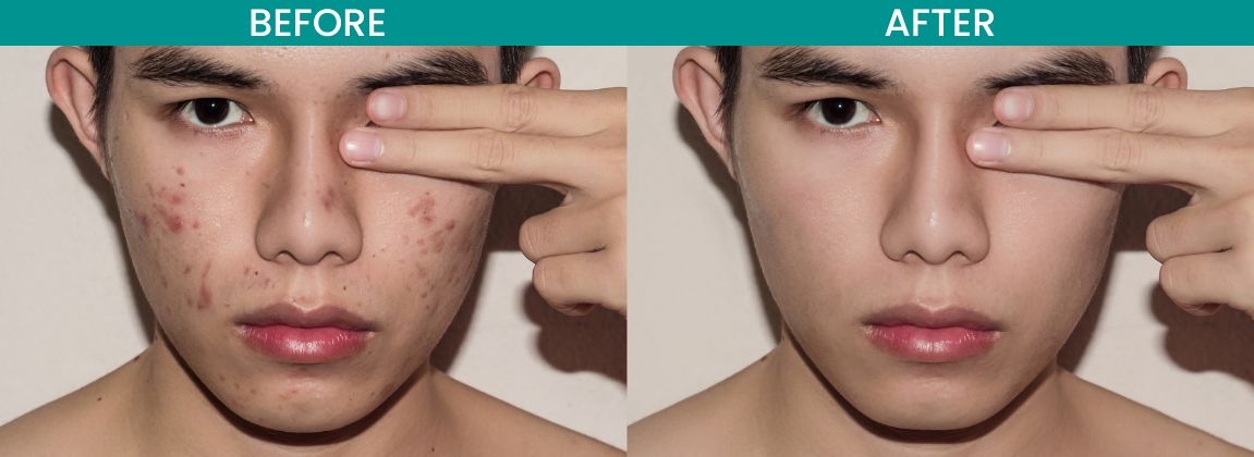 Acne Scar Treatment Malaysia