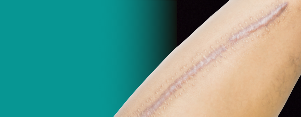 What Are the 3 Types of Scars? – Biodermis