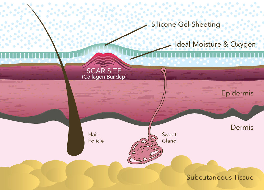 Bundle: Epi-Derm Areopexy Package