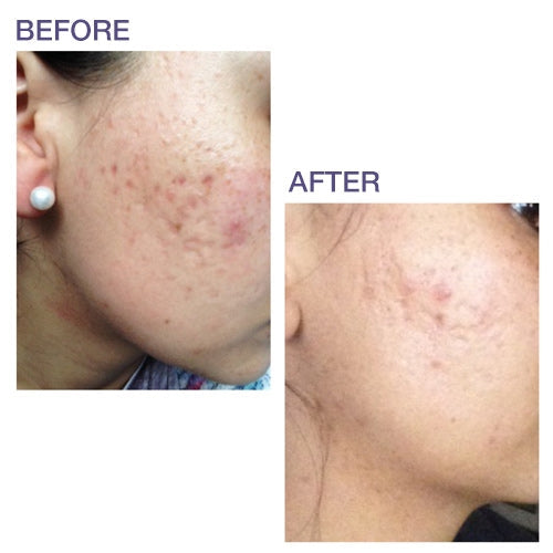 Procil Pro-Sil 17g Scar Stick: Patented, Effective Scar Treatment | BIODERMIS ...